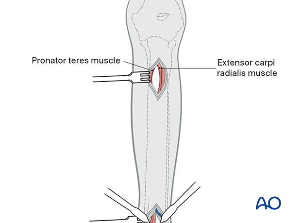 D23_A130_i080 Cranial skin incision distal to the elbow joint line and over the body of the extensor carpi radialis muscle.