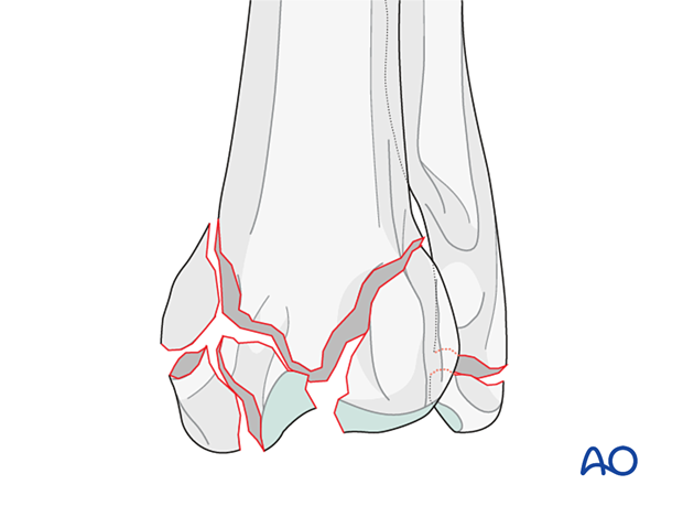 D23_D00_i160 Multifragmentary articular fracture of the distal epiphysis and metaphysis of the radius and ulna in the dog