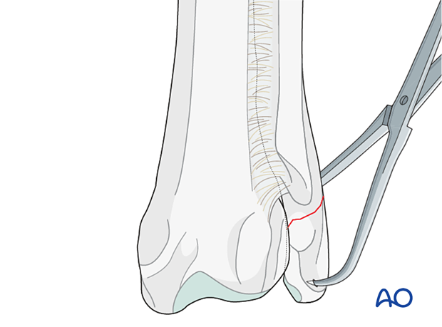 D23_P100_i060 Manipulation of the distal fragment with pointed reduction forceps