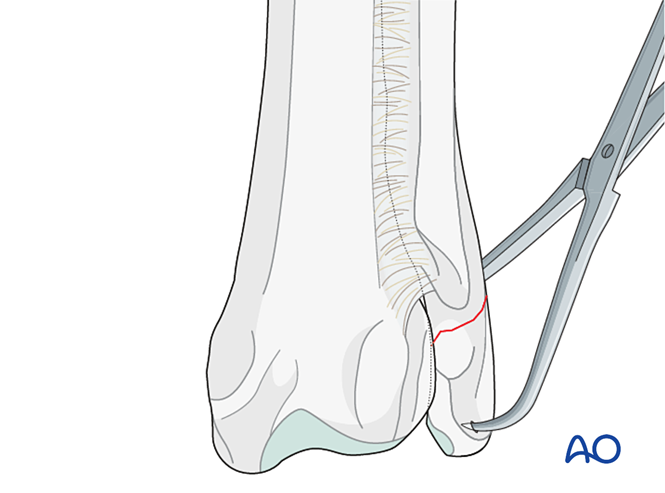 K-wire with or without tension band for Simple extraarticular fracture ...