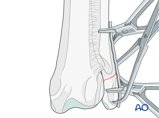 D23_P100_i140 Application of the contoured plate to the lateral surface of the bone