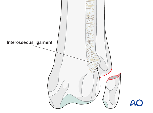 D23_P110_i030 Proximal fragment connected to the proximal radius through the interosseous ligament