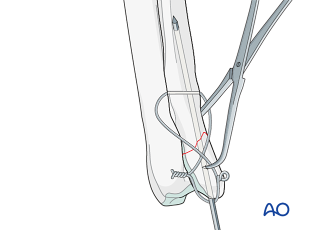 D23_P120_i200 Double knot technique is preferred