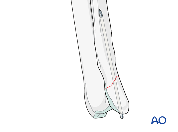 D23_P120_i280 K-wire without tension band wire can be an option