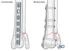 Compression plate fixation