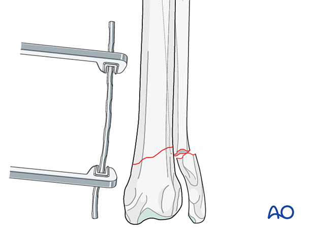 Appropriately sized plate is contoured to fit the distal radius