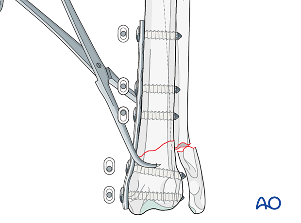 Insertion of all remaining screws in neutral mode