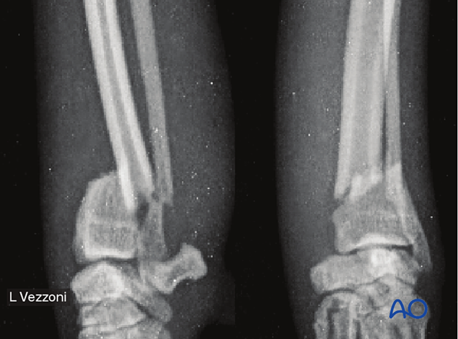 Release notes - Dog distal radius and ulna