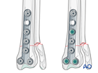 T-plate fixation