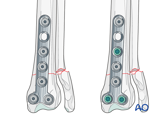 T-plate fixation of 23-A2 fractures
