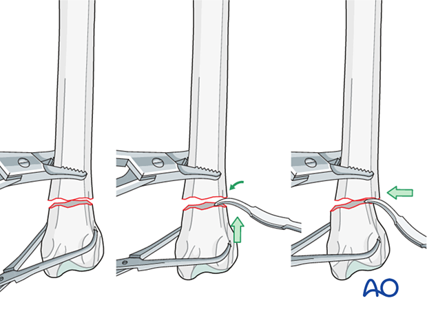 Use of a Hohmann retractor as a lever to align fragments