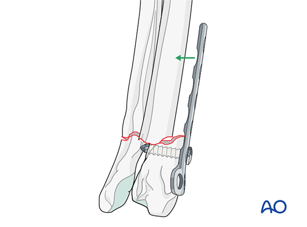 Plate fixation in the distal fragment to achieve reduction on the proximal fragment
