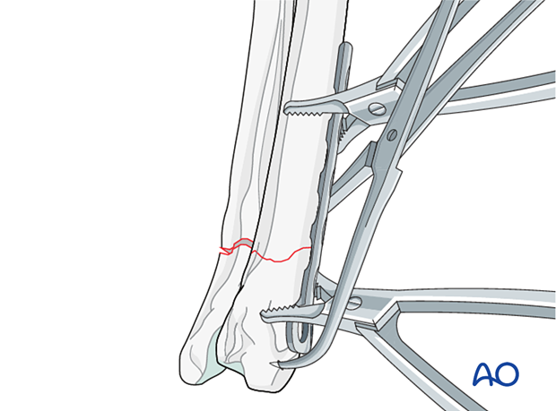 Application of the contoured plate on the cranial surface of the distal radius and securing with plate-holding forceps