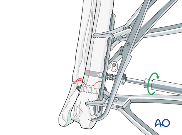 Insertion of second cortical screw in the proximal fragment