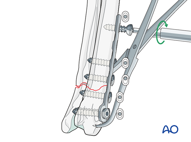 Insertion of the remaining cortical screws in neutral mode