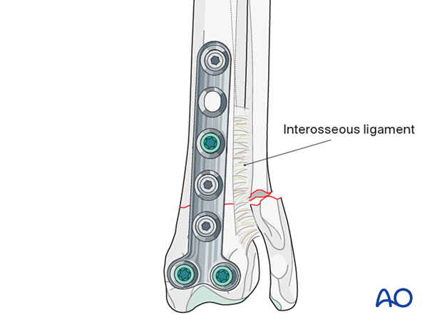 Fracture fixation of the radius with T-plate and, only if necessary, fracture fixation of the ulna