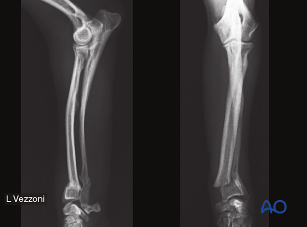 D23_P123_i340 23-A2 fracture in a 10-month-old dog