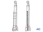 Bridging plate fixation