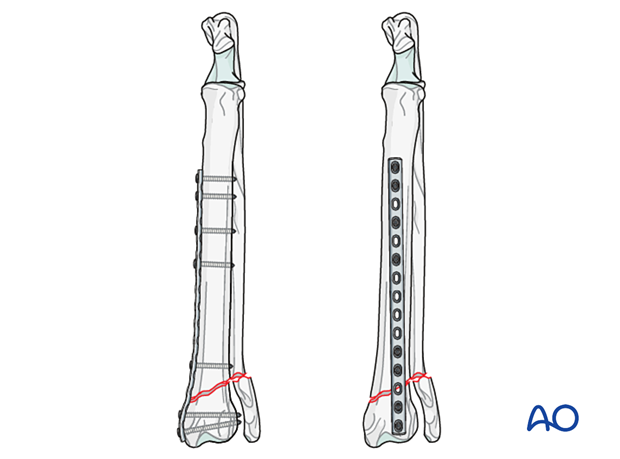 Bridging plate fixation of 23-A2 fractures