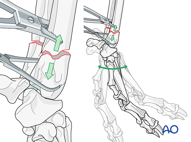 Distraction and alignment of the major bone segments using bone-holding forceps
