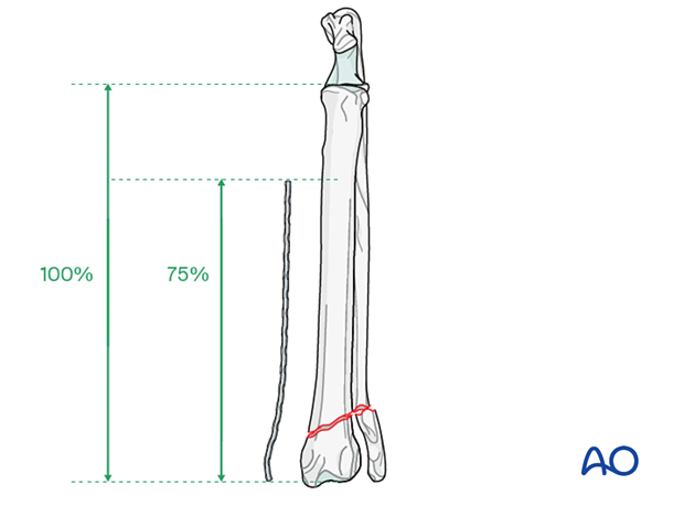 Plate should bridge at least 75% of the length of the radius