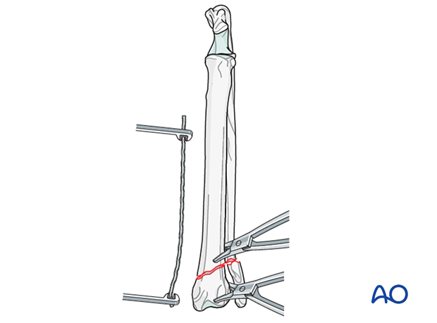Appropriately sized plate is contoured to fit the distal radius