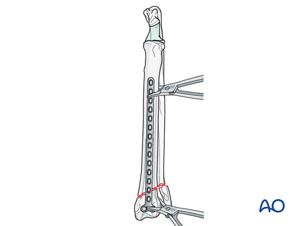 Positioning the T-plate on the cranial surface of the radius