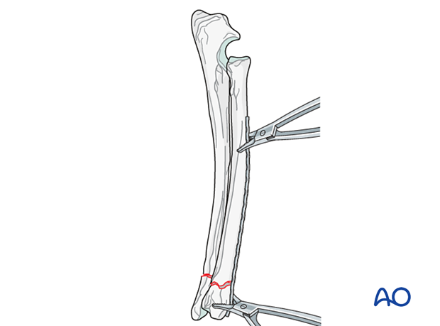 Application of the contoured plate on the radial surface and securing with plate-holding forceps