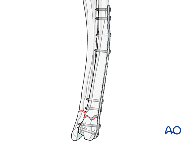 Insertion of at least two cortical screws in the distal fragment and three in the proximal fragment
