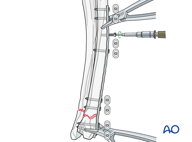 Insertion of the screws in neutral mode