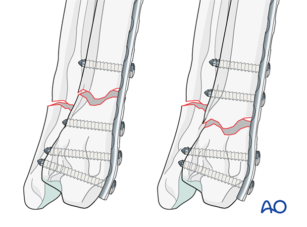 Insertion of a minimum of two screws is required