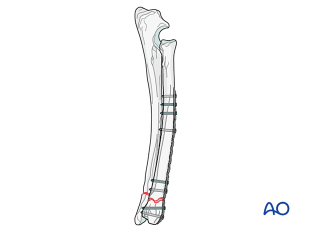 Use of a combination of screws requires an anatomically contoured plate