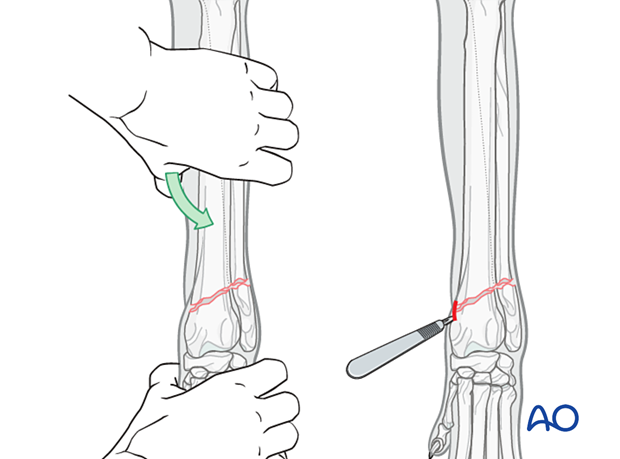 Closed reduction of 23-A2 fractures when possible