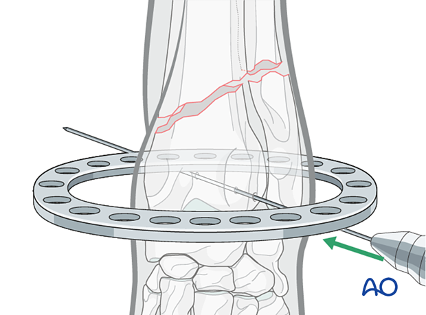 Ring fixator with an appropriately sized ring placed on the limb and a K-wire placed in a craniolateral to caudomedial direction