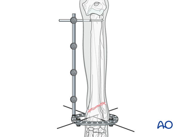 Assembly of ESF: a hybrid connector rod coupled to the ring on the medial side and three to four clamps placed on the connector rod