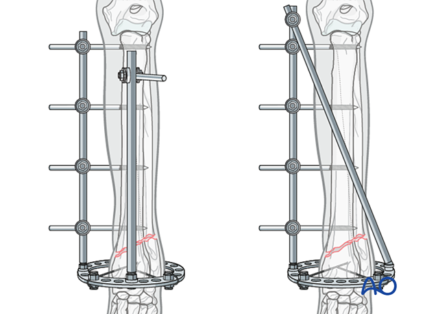 Additional craniocaudal half-pin in the proximal segment for less stable comminuted fractures