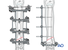 External skeletal fixation
