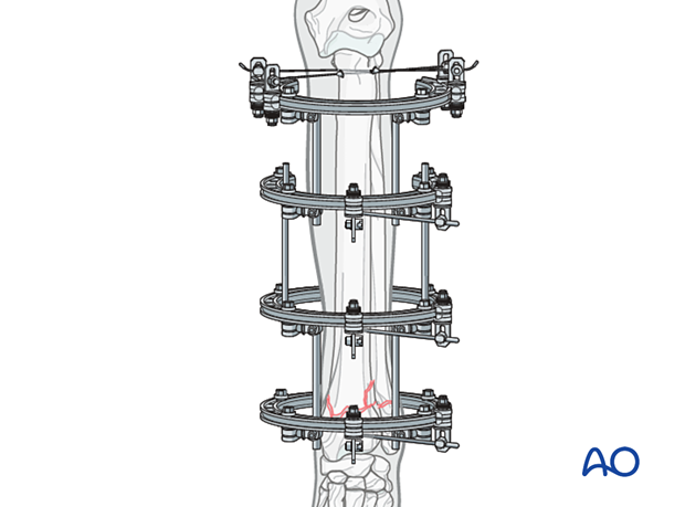 D23_P126_A3_i200 Circular ESF used for management of juxta-articular fractures