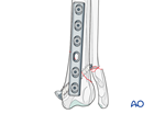 Lag screw and neutralization plate fixation