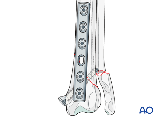 Lag screw and neutralization plate fixation of 23-A2 fractures