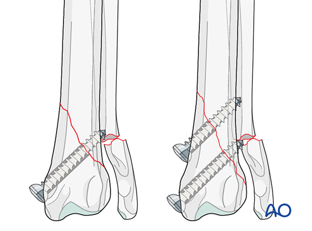 Securing an oblique fracture with lag screws