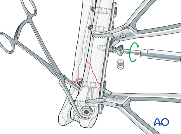 Insertion of screws not close or at the level of the fracture line