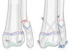 K-wire fixation