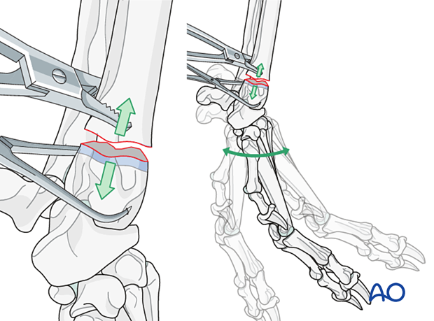 D23_P130_i060 Application of bone-holding forceps on the proximal fragment