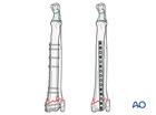 D23 I300 A3 multifragmentary radial