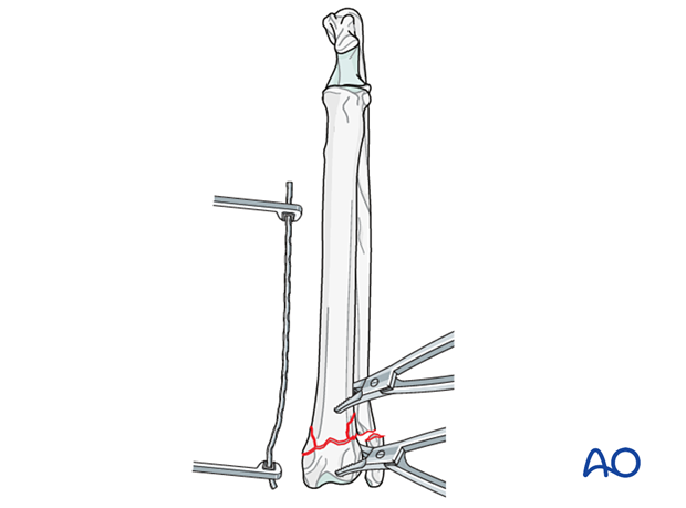 D23_P135_i120 Appropriately sized plate is contoured to fit the distal radius