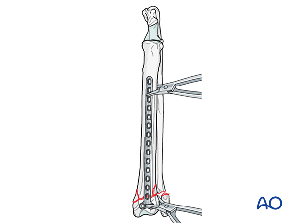 D23_P135_i160 Positioning the T-plate on the cranial side in more distal fractures