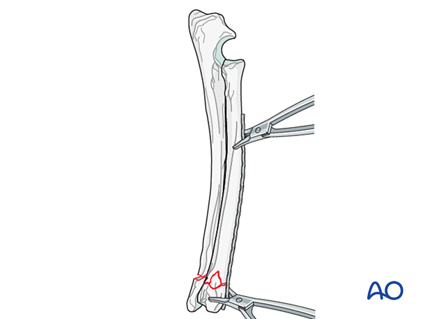 D23_P135_i180 Application of the contoured plate on the radial surface and securing with plate-holding forceps