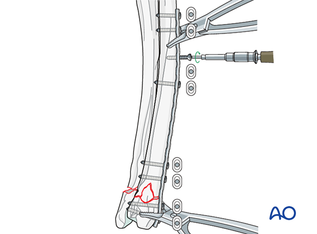 D23_P135_i240 Insertion of the screws in neutral mode