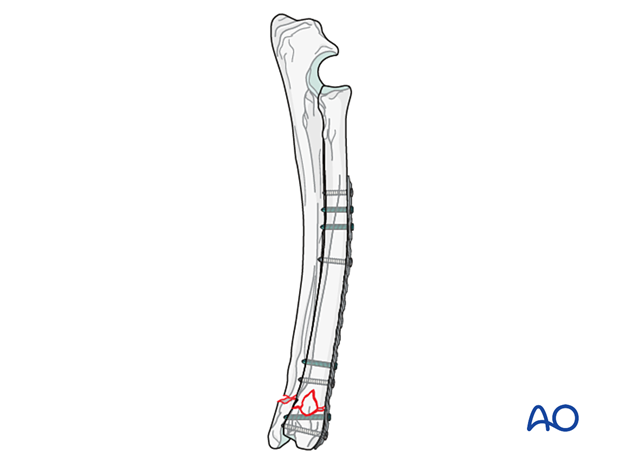 D23_P135_i280 Fixation with a locking plate instead of a traditional bone plate and a combination of nonlocking and locking screws or locking screws alone